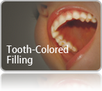 Tooth-Colored Filling