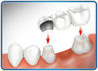 Dental Bridge