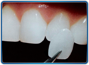 Dental Veneers